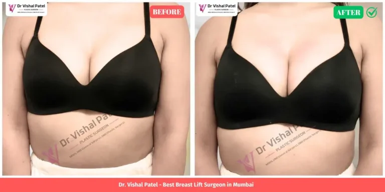 Inverted Anchor Breast lift before and after surgery in Mumbai India - By Dr. Vishal Patel