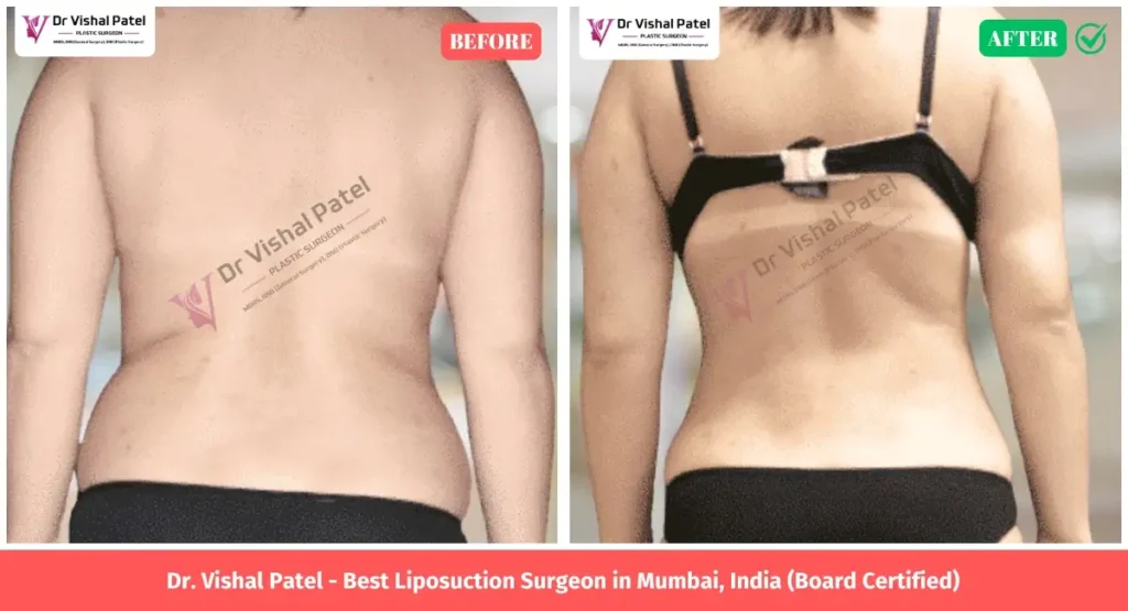 Love Handle Liposuction Before after photo in Mumbai India - Indian Female