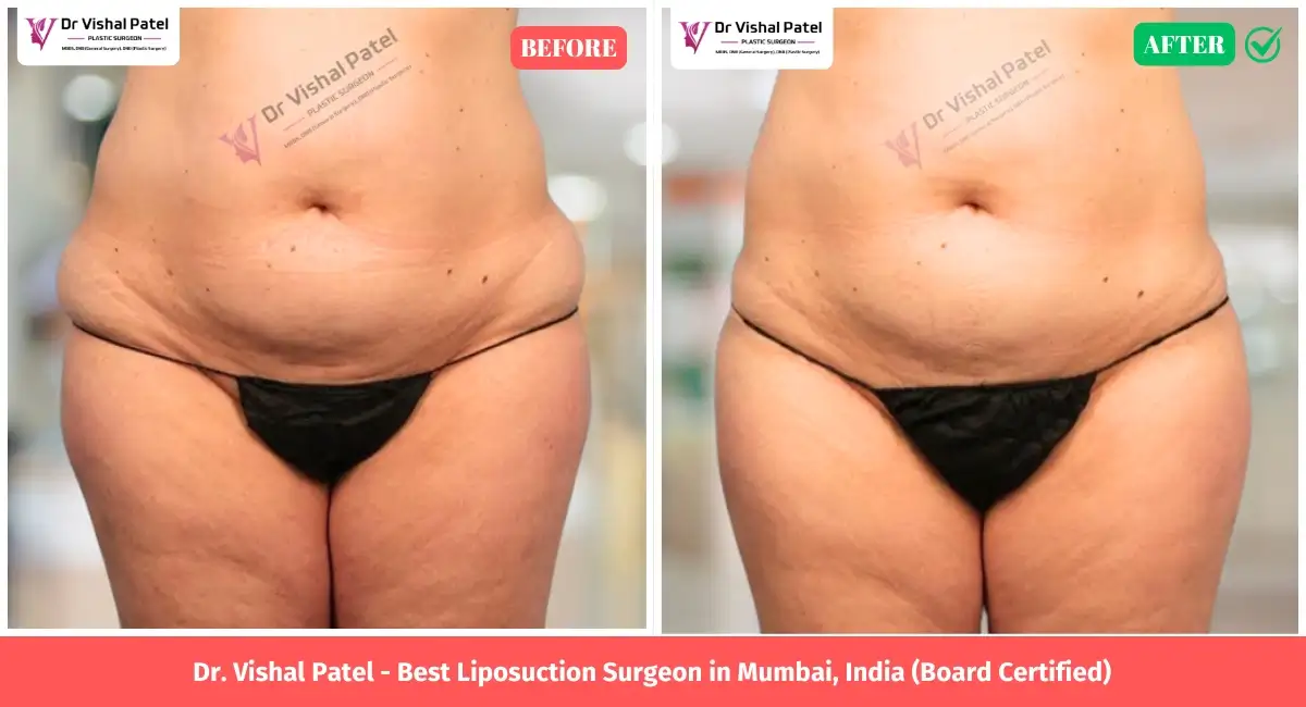 Love Handle Liposuction Before after photo in Mumbai India