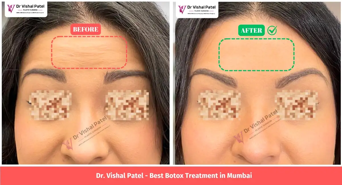 Before After Botox Injections Treatment in Mumbai for Forehead Wrinkles by Dr. Vishal Patel
