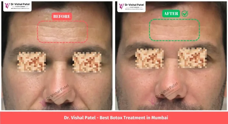 Before After Botox Treatment for Fine Lines for Men in Mumbai