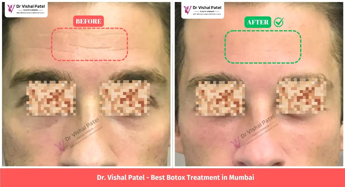 Indian Man Face Showing Markings of Botox Treatment Results.