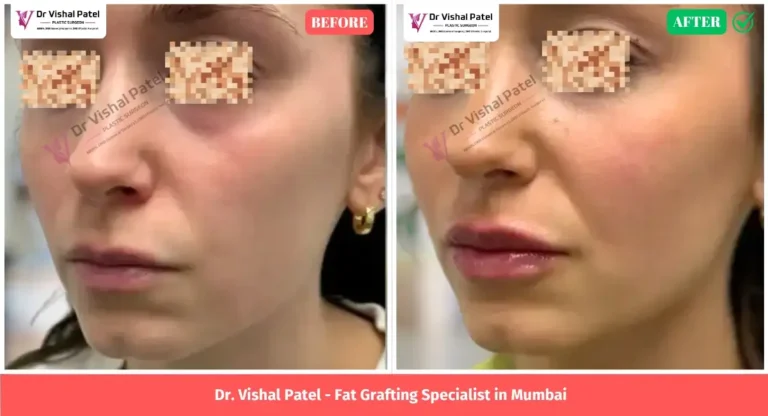 Cheeks Fat Grafting Before After Surgery in Mumbai India - by Dr. Vishal Patel