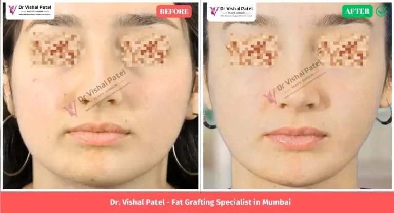 Facial Fat Transfer in Mumbai - Before After Photo by Dr. Vishal Patel