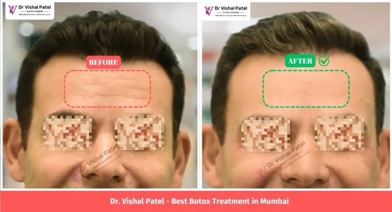 Indian Man Before After Botox Treatment Photo in Mumbai India.