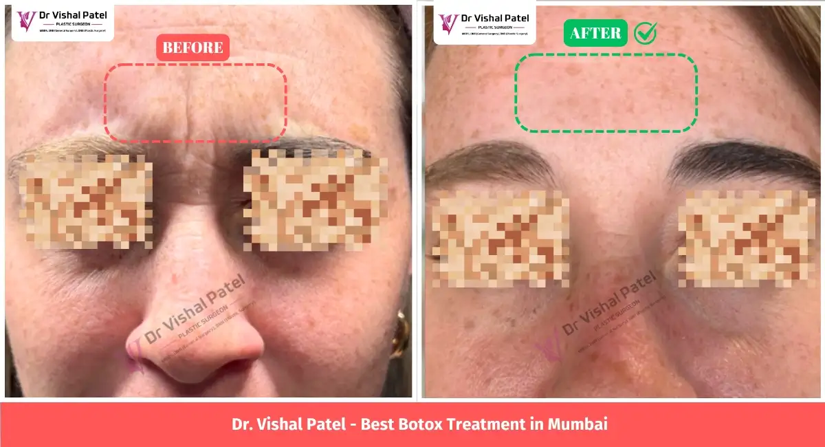 Forehead Lines Botox Treatment Before After Photo of Indian Women