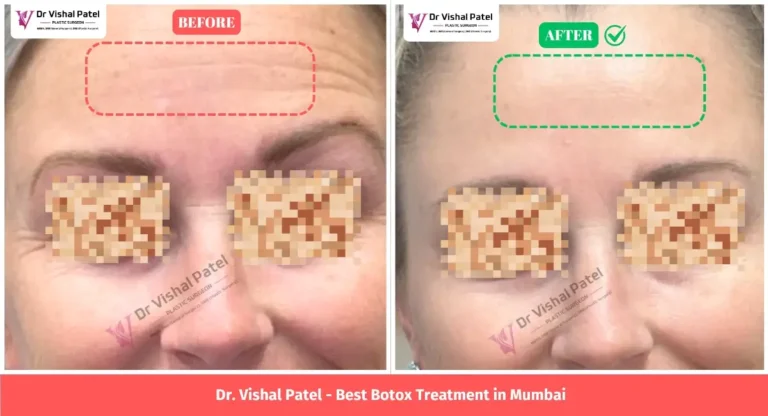 Fine Lines Botox Treatment Before After Photo of Women in Mumbai, India.