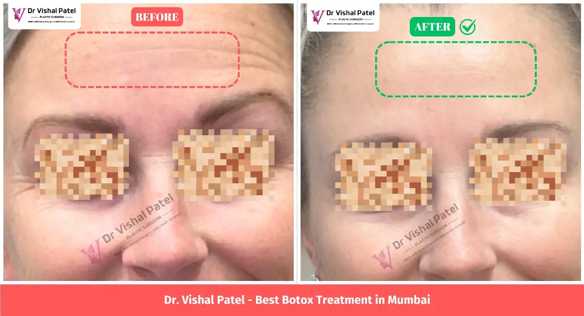 Fine Lines Botox Treatment Before After Photo of Women in Mumbai, India.