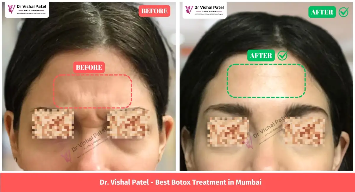Forehead Lines Botox Treatment Before After Photo of Indian Women.