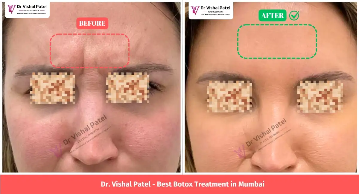 Before After Photo of Women Face with Frown line between eyes.