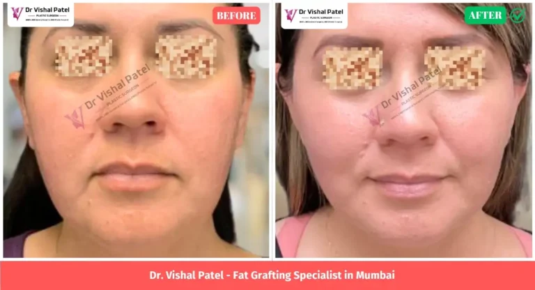Full Face Fat Grafting in Mumbai Before After Surgery - by Dr. Vishal Patel