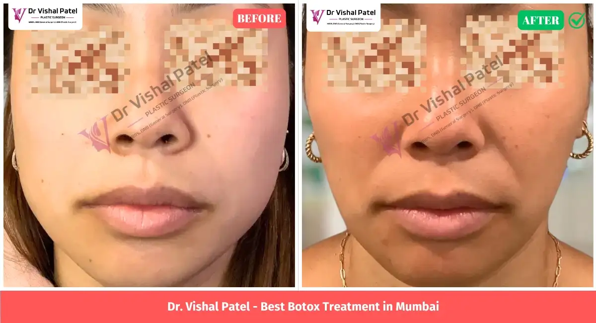 Women Face Showing Masseter Botox Treatment in Mumbai India.