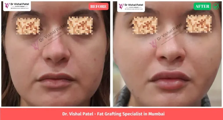 Under Eye Fat Grafting in Mumbai - Before & After Surgery
