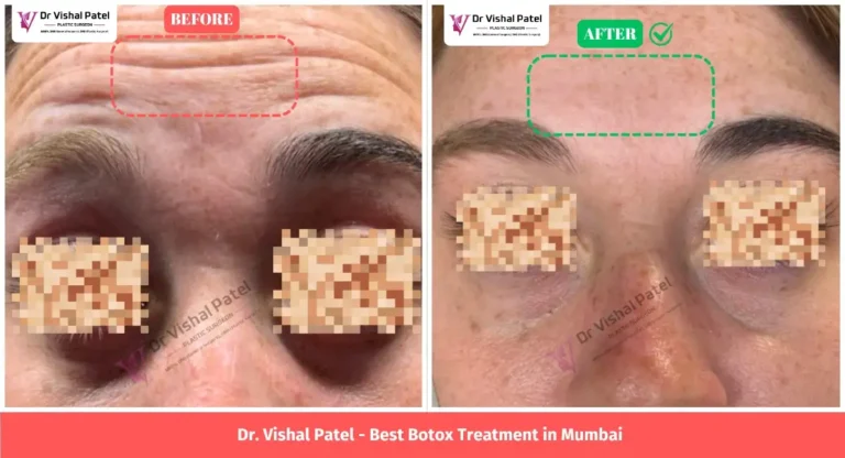Wrinkle Removal Using Botox Treatment - Before & After in India