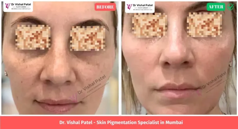 Female Skin Pigmentation in Mumbai by Dr. Vishal Patel