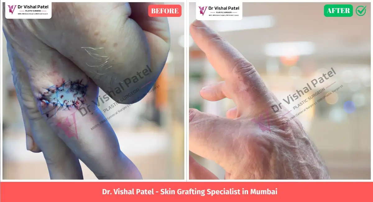 Fingers Skin Grafting in Mumbai Before and After Photo