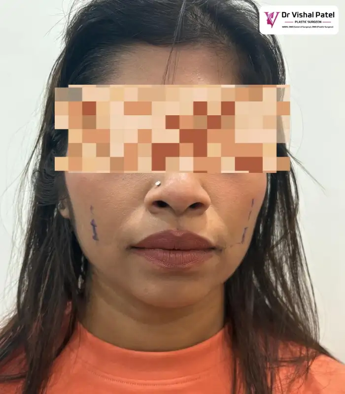 Patient face with dimple markings done.