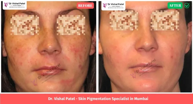Red Skin Pigmentation Treatment in Mumbai by Dr. Vishal Patel