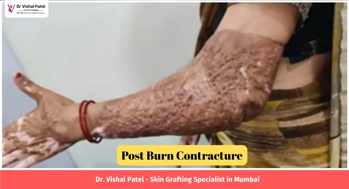 Post skin grafting surgery photo.