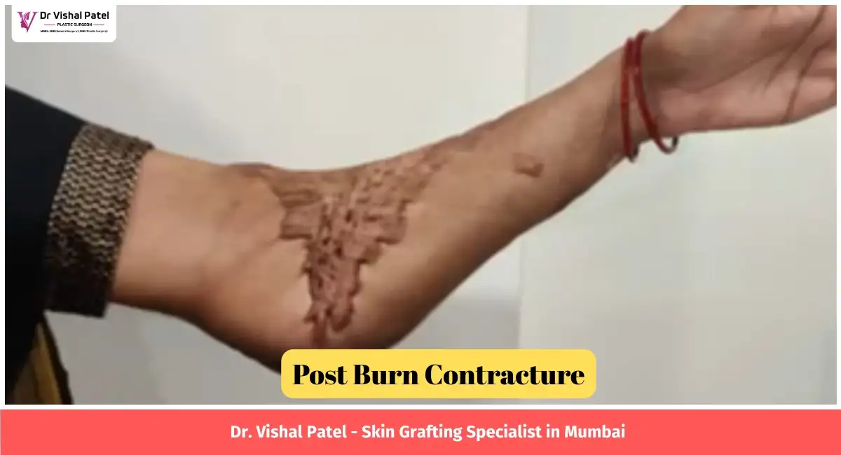Hand after skin grafting done for burn contracture.