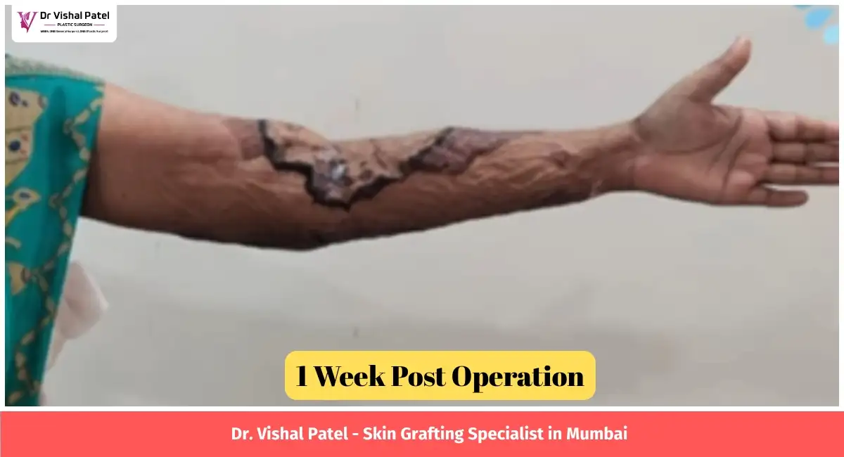 Hand skin grafting result after 1 week of surgery.