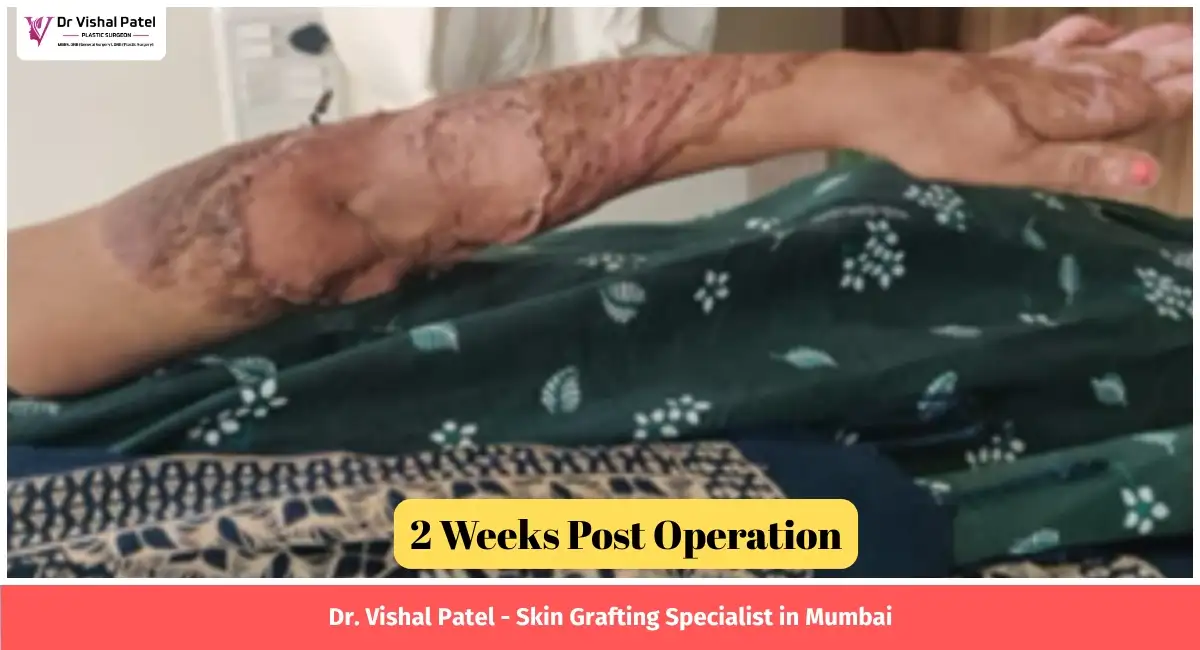 Hand skin grafting result after 2 weeks of surgery.