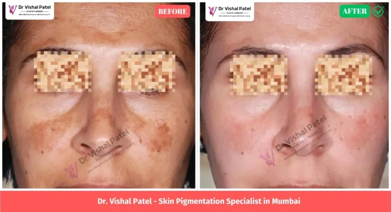 Skin Pigmentation Treatment in Mumbai - Before After Photo