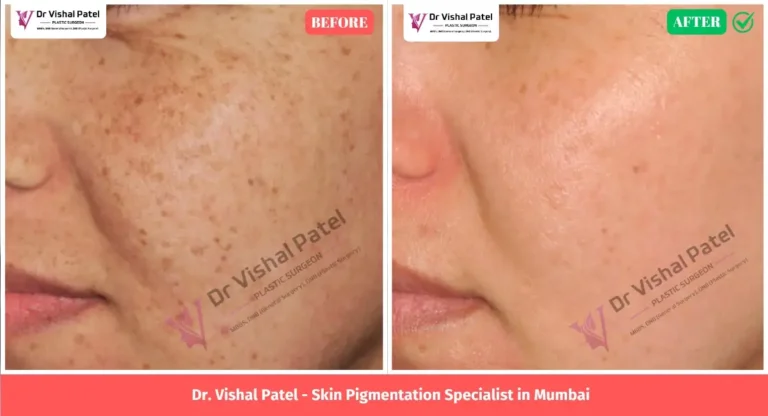 Skin Pigmentation by Acne - Treatment Before After Photo
