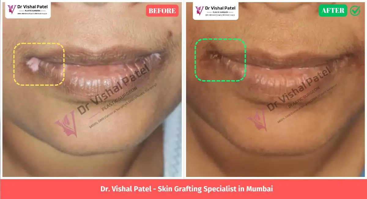 Skin grafting in Mumbai for Vitiligo - Before and After Surgery Photo