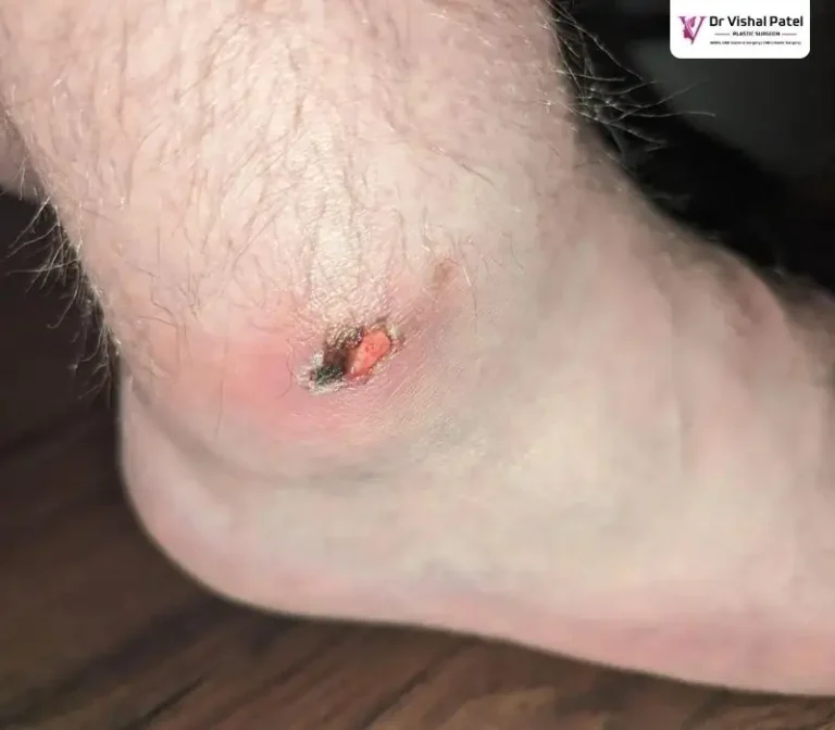 Bed sore on Ankle foot in Mumbai