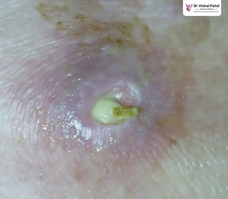 Bed sore on buttock - Stage 3 Bed sore case