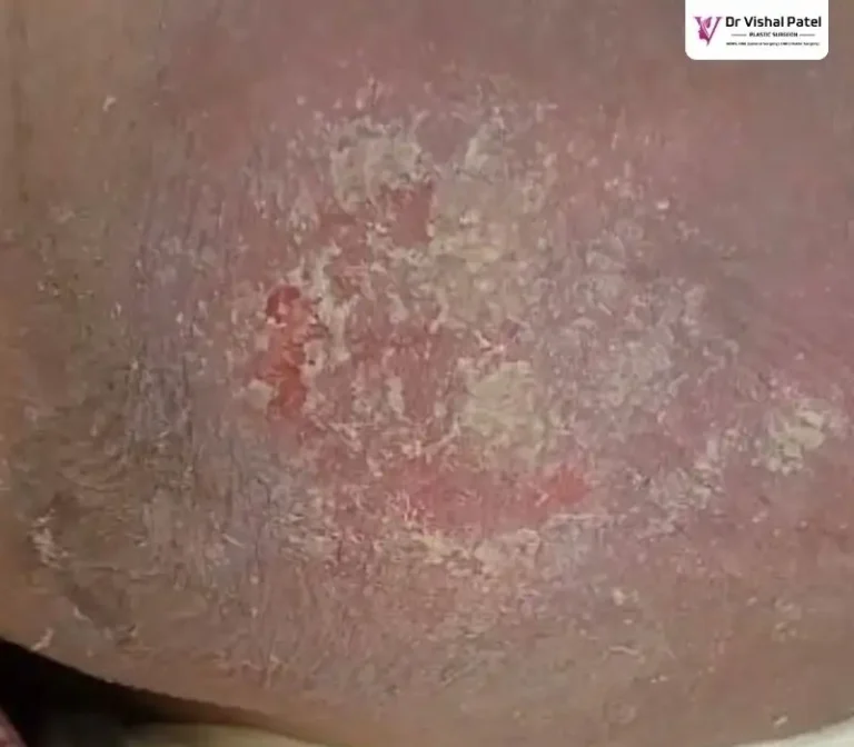 Bed sore on buttock in India - Stage 2 Bed Sores