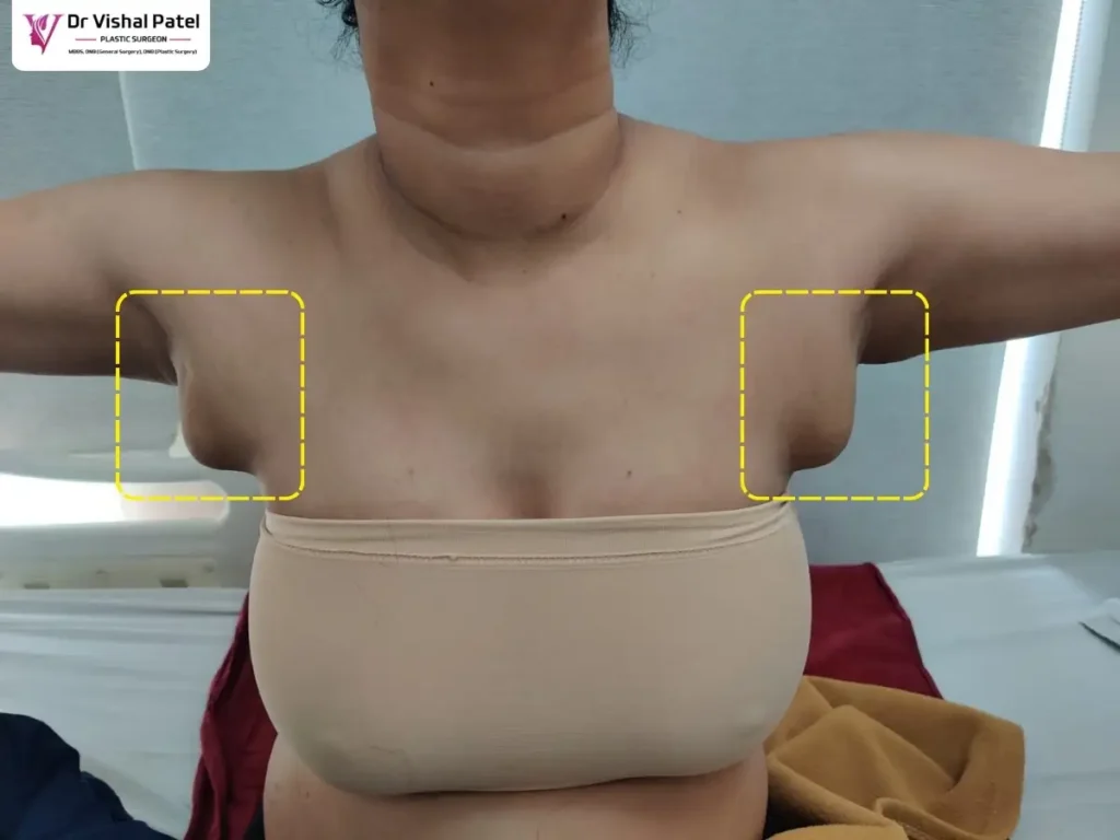 Bilateral axillary breast tissue in women with hands up.