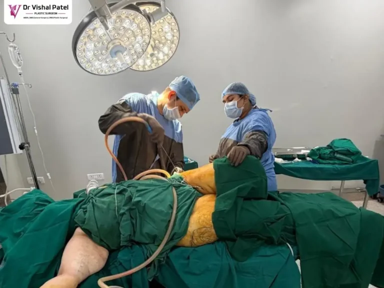 Dr. Vishal Patel doing Thigh Liposuction in Mumbai.