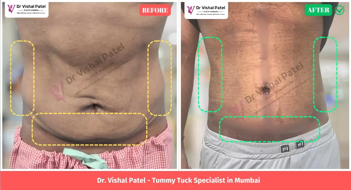 Fleur-De-Lis Abdominoplasty Surgery Before After Photo by Dr. Vishal Patel