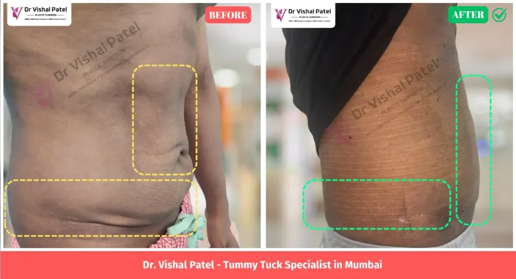 Fleur-De-Lis Tummy Tuck Surgery Before After Photo in Mumbai India