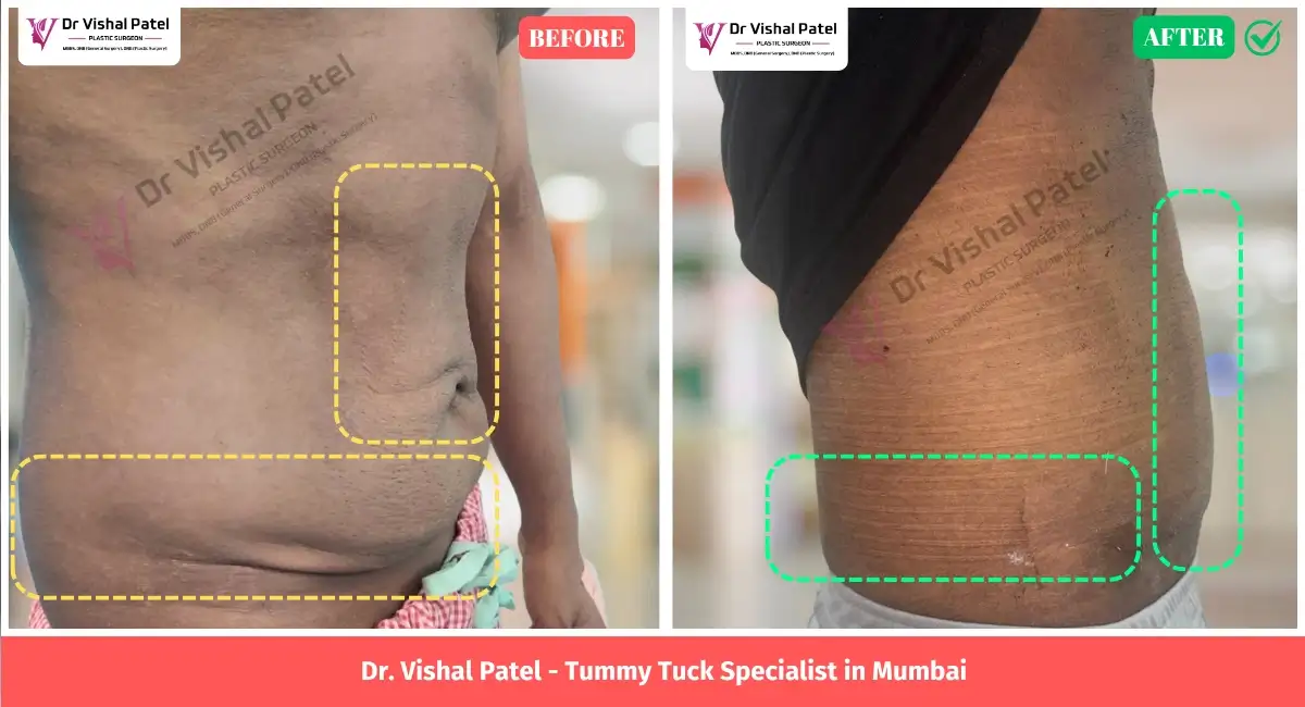 Fleur-De-Lis Tummy Tuck Surgery Before After Photo in Mumbai India