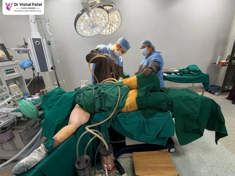 Live Thigh Liposuction in Mumbai by Dr. Vishal Patel