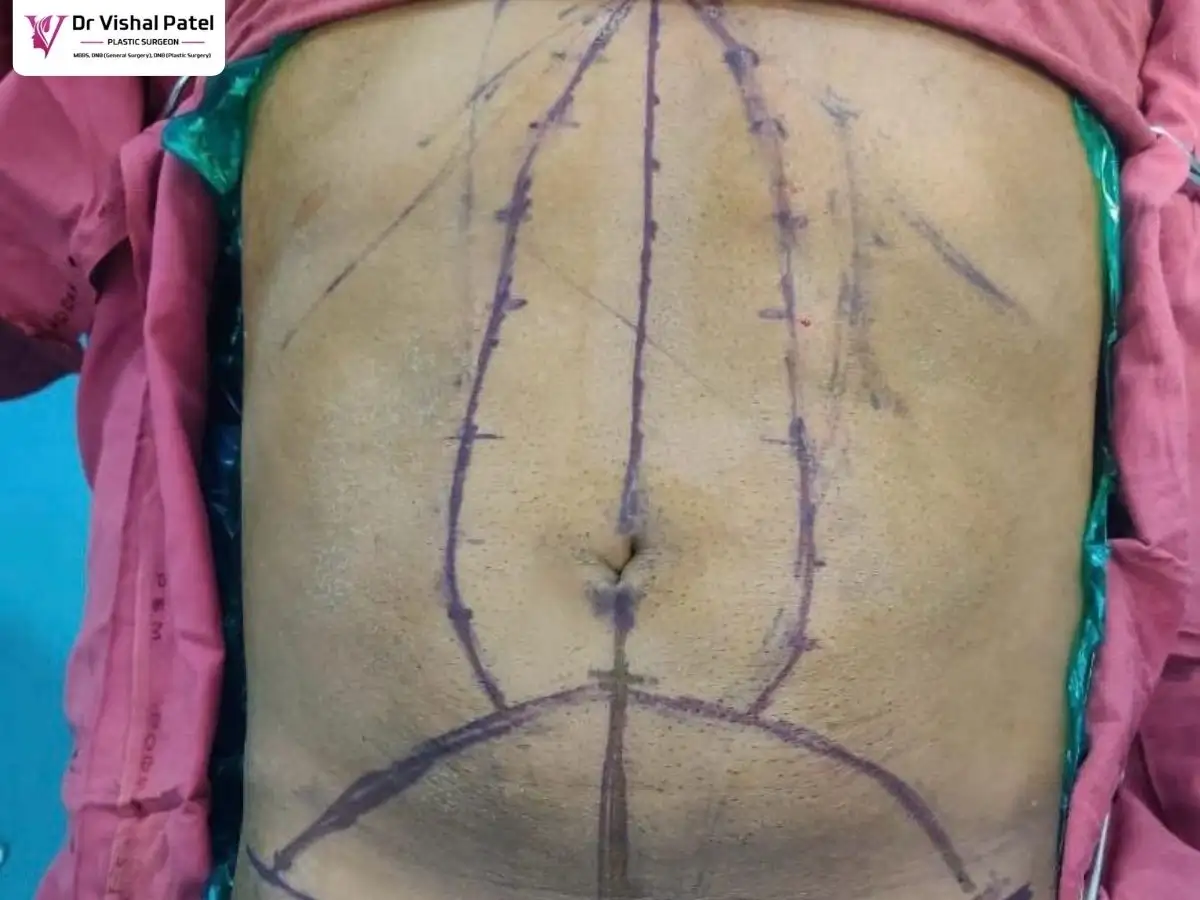 Markings for Fleur-de-lis Tummy tuck surgery in Mumbai
