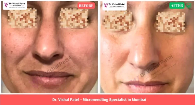 Microneedling Treatment by Dr. Vishal Patel in Mumbai