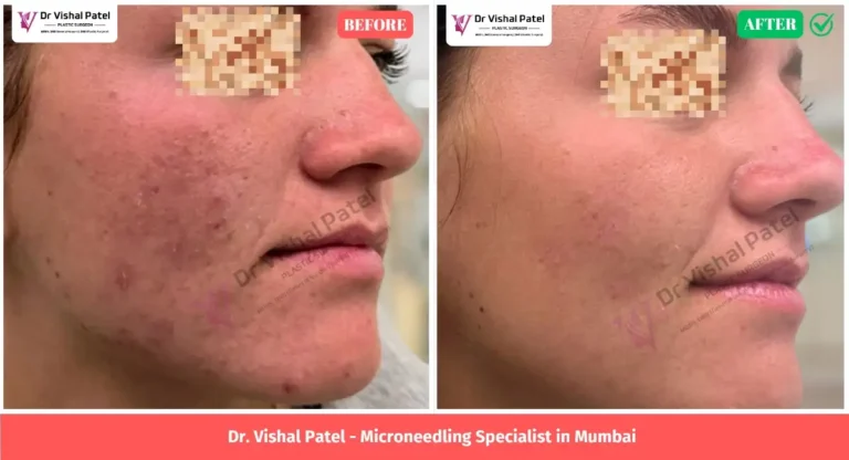 Microneedling Treatment in Mumbai - Before After Photo Indian Female