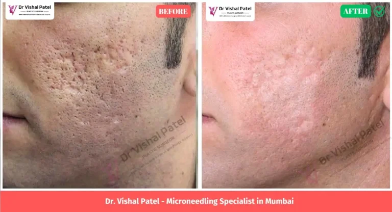 Microneedling Treatment in Mumbai - Before After Photo Indian Male