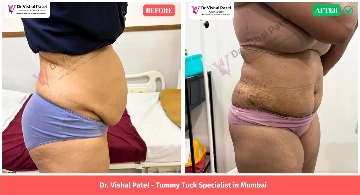 360 Liposuction Tummy Tuck Before After Photos in Mumbai by Dr. Vishal Patel