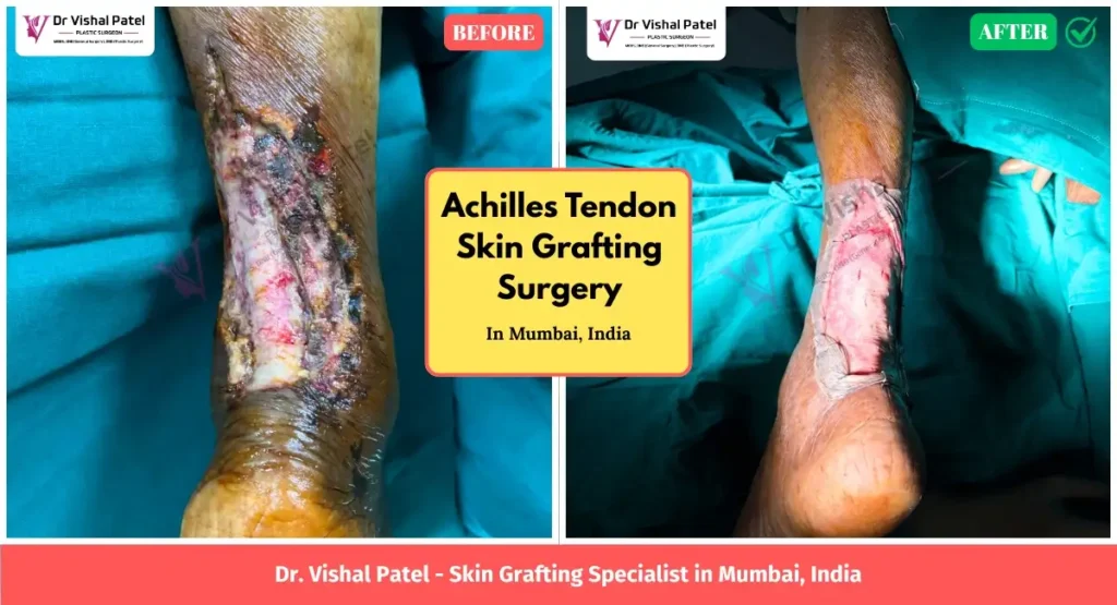 Achilles Tendon in Legs skin grafting in Mumbai India - Before After Surgery Photo