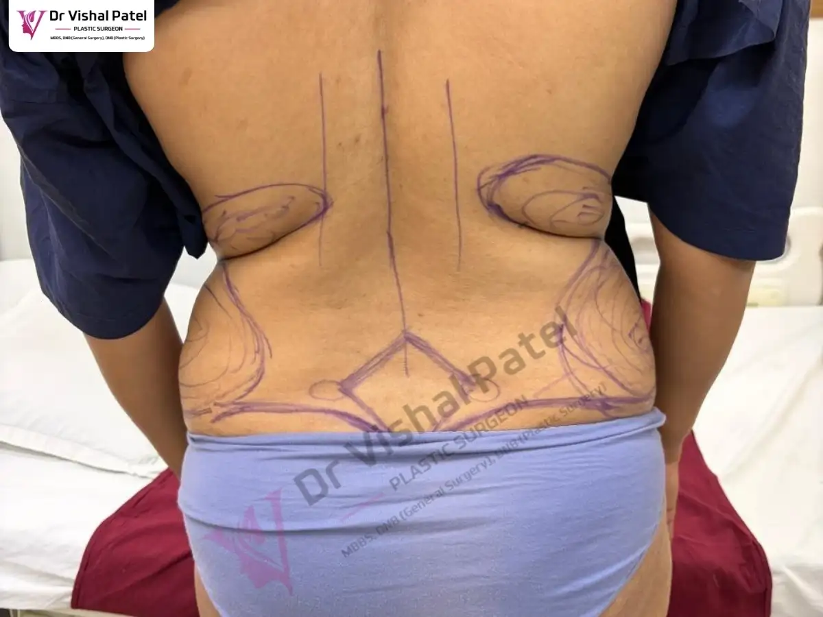 Back Side marked with pen before tummy tuck.