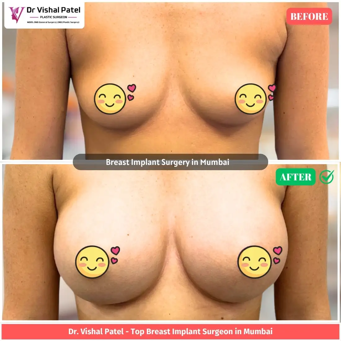 Breast Augmentation Before After in Mumbai India - By Dr. Vishal Patel