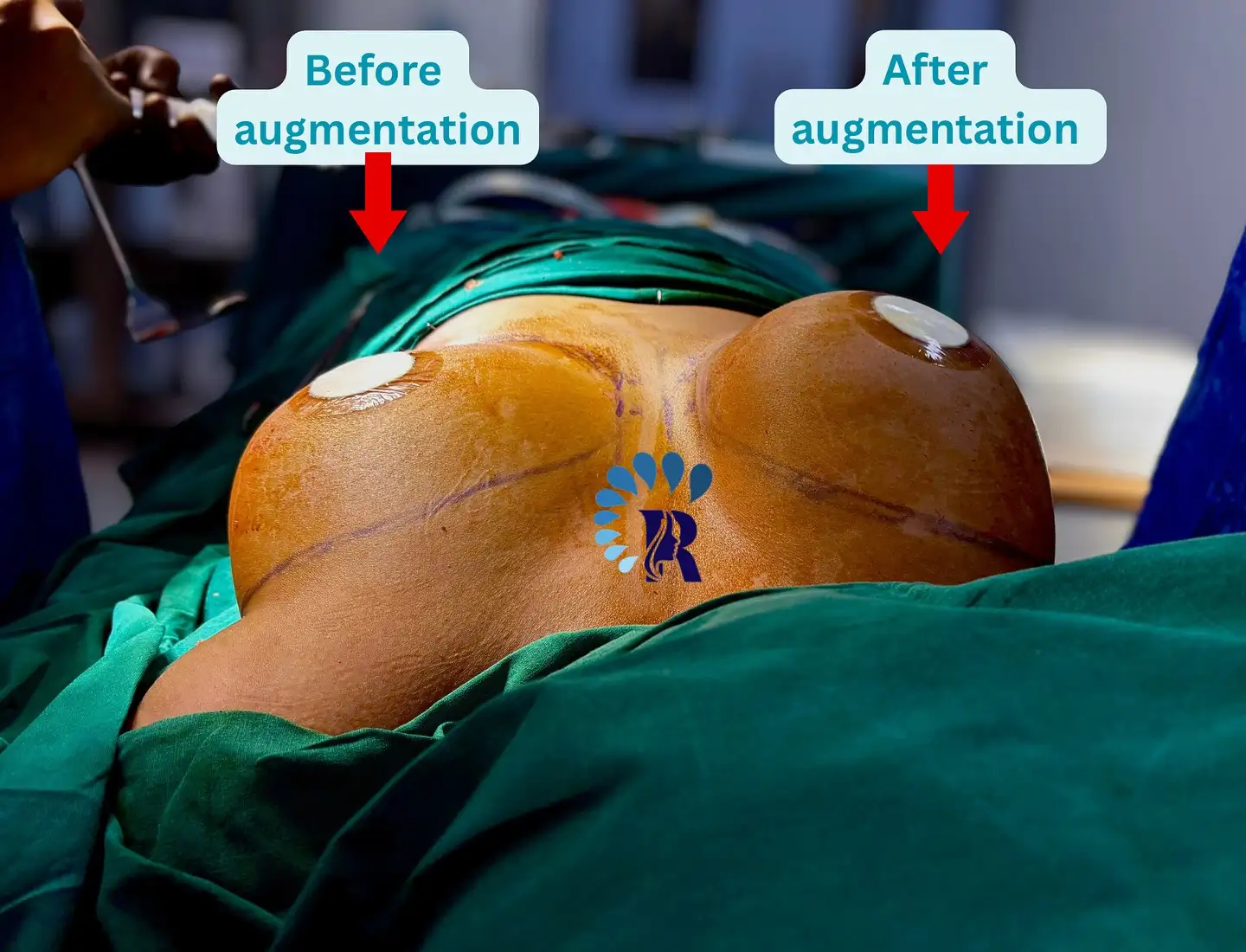 Breast enlargement in Mumbai before after photo by Dr. Vishal Patel