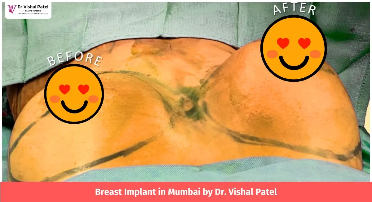Breast implant before after in India by Dr. Vishal Patel