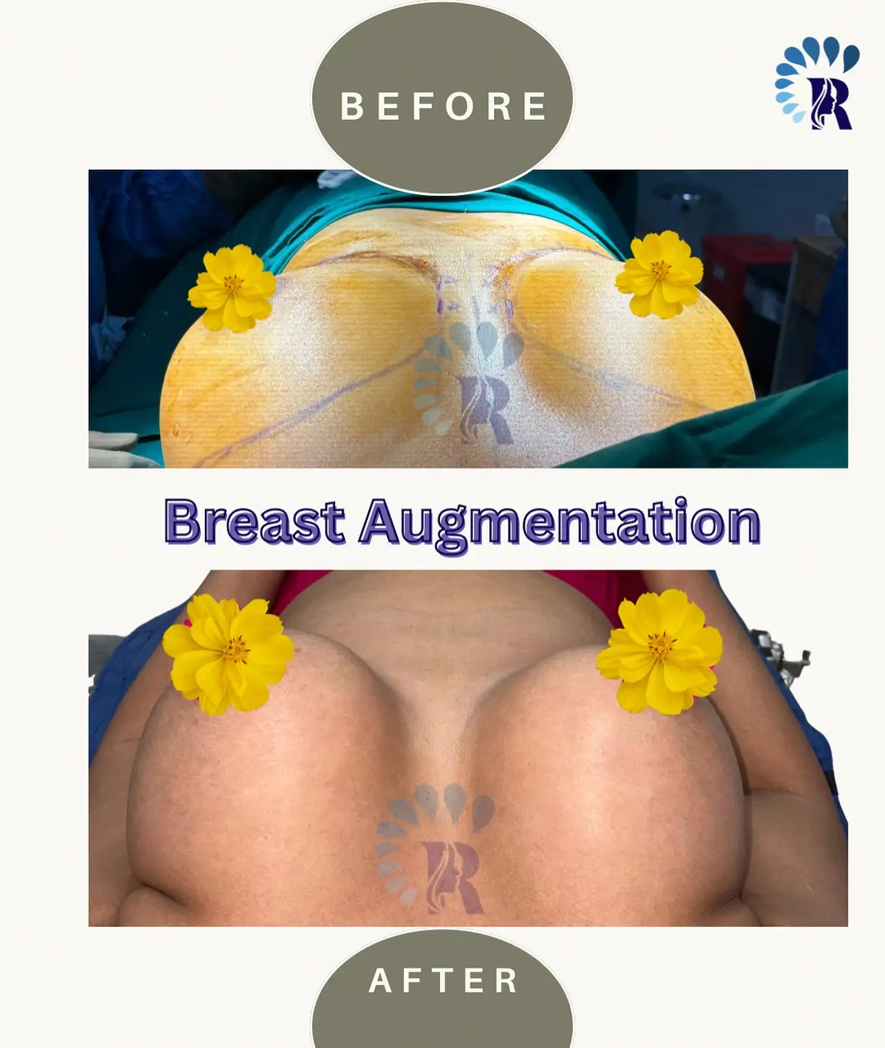 Breast implant before after surgery in Mumbai by Dr. Vishal Patel