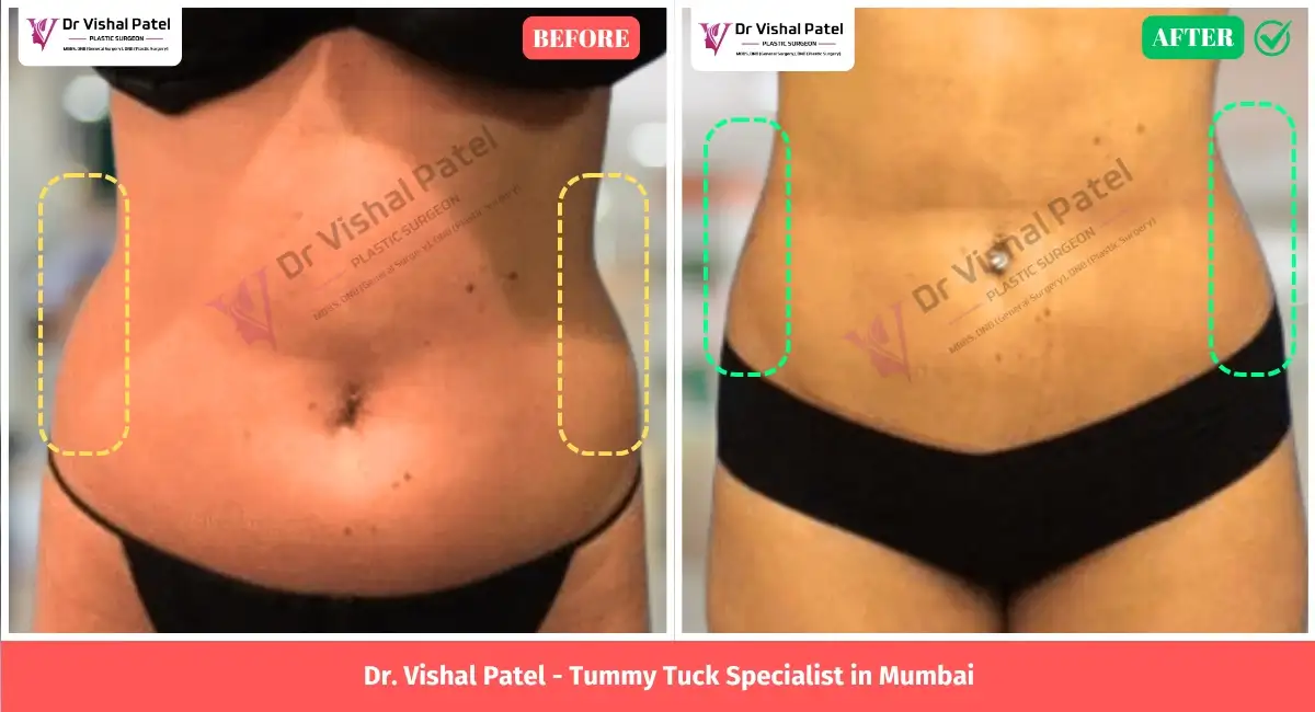 Female Tummy tuck before after photo in Mumbai, India